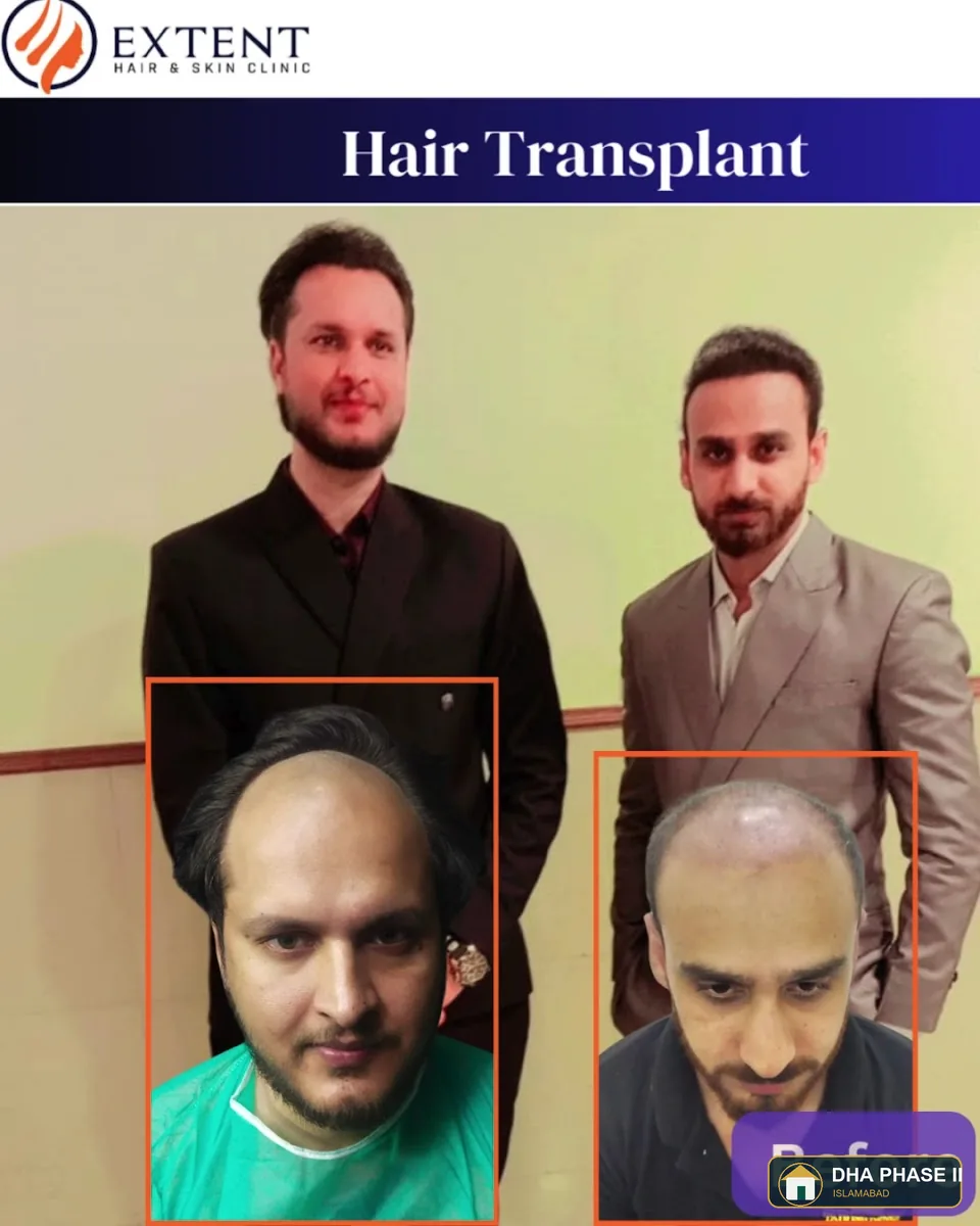 Hair Transplant & Skin Aesthetics Solution Laser Islamabad Pakistan Top Consultant in DHA Phase II Islamabad