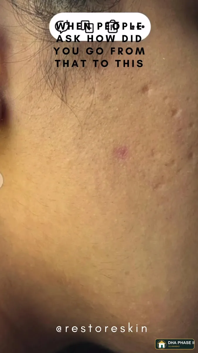 Restore Skin by Dr. Namrah Aziz | FCPS Best Dermatologist in Islamabad in DHA Phase II Islamabad — photo 2